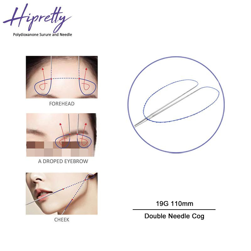 Korea facial lifting treatment mono screw tornado cog molding cone double needle multi threads 18G 19G 21G 26G 27G 29G 30G 25.4mm 38mm 50mm 60mm 90mm 100mm plla pcl pdo thread lift